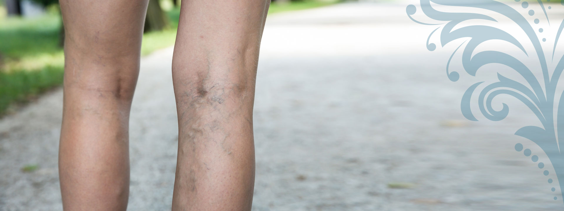 Varicose Veins - Arkansas Vein Clinic and Skin Care