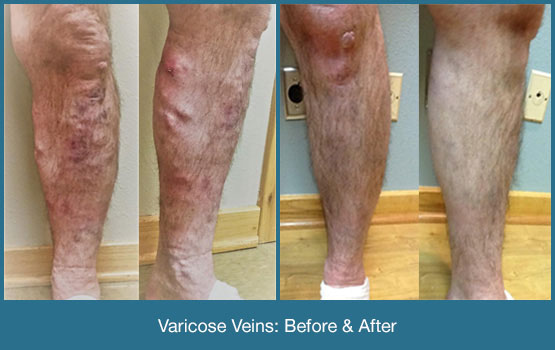 Varicose Veins Before & After Photo